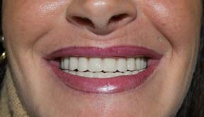 restauration dentaire implant basal bulgarie