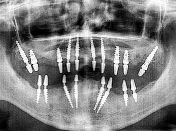 implant-basal-bulgarie