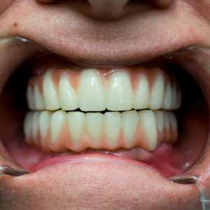 Implant basal et dents devitalisées