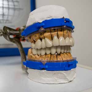 Restauration 2 machoires avec implant basal