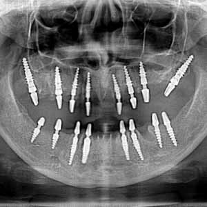 implant-basal-bulgarie-dr-genchev