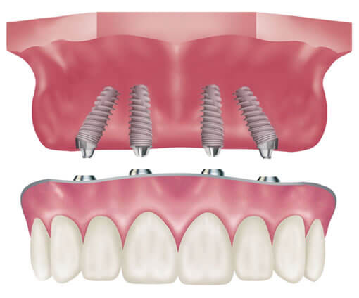 All on 4 en Bulgarie avec implant dentaire