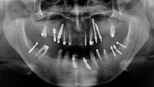 implant-basal-bulgarie-dentiste-restauration